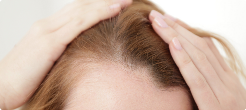 Łysienie poporodowe – ile trwa wypadanie włosów po ciąży?